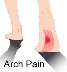 Arch-Pain