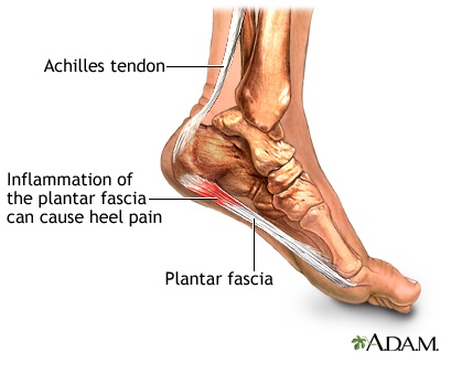 Plantar-Fasciitis, Achilles tendon