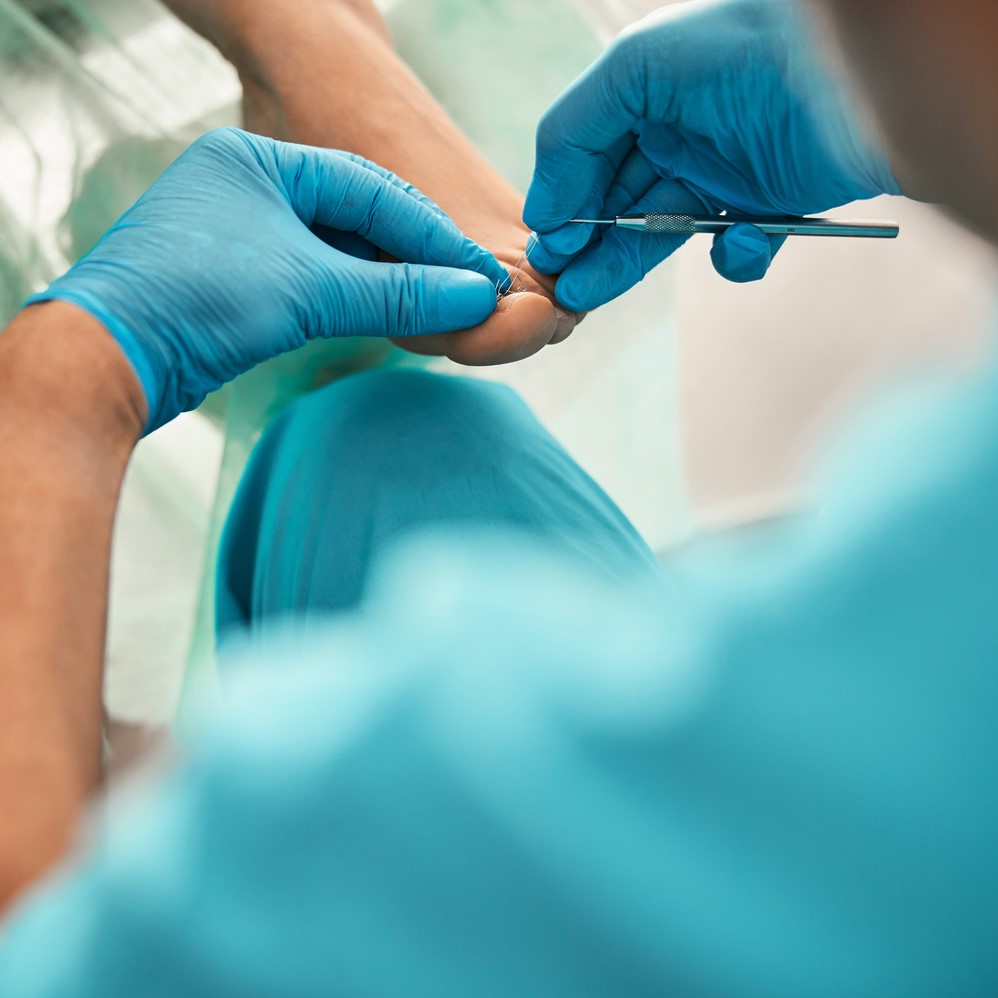 Competent chiropodist wearing uniform during work while doing treating procedure for ingrown toenail. Treat ingrown toenails.