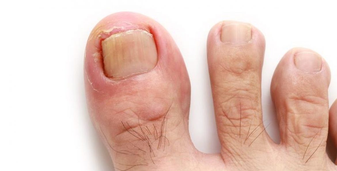 Ingrown Toenails – Causes, Symptoms and Remedies