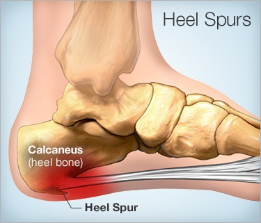 Heel Spur Feet – Causes and Treatment