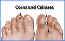 Causes of Corns and Calluses & How to Treat Them
