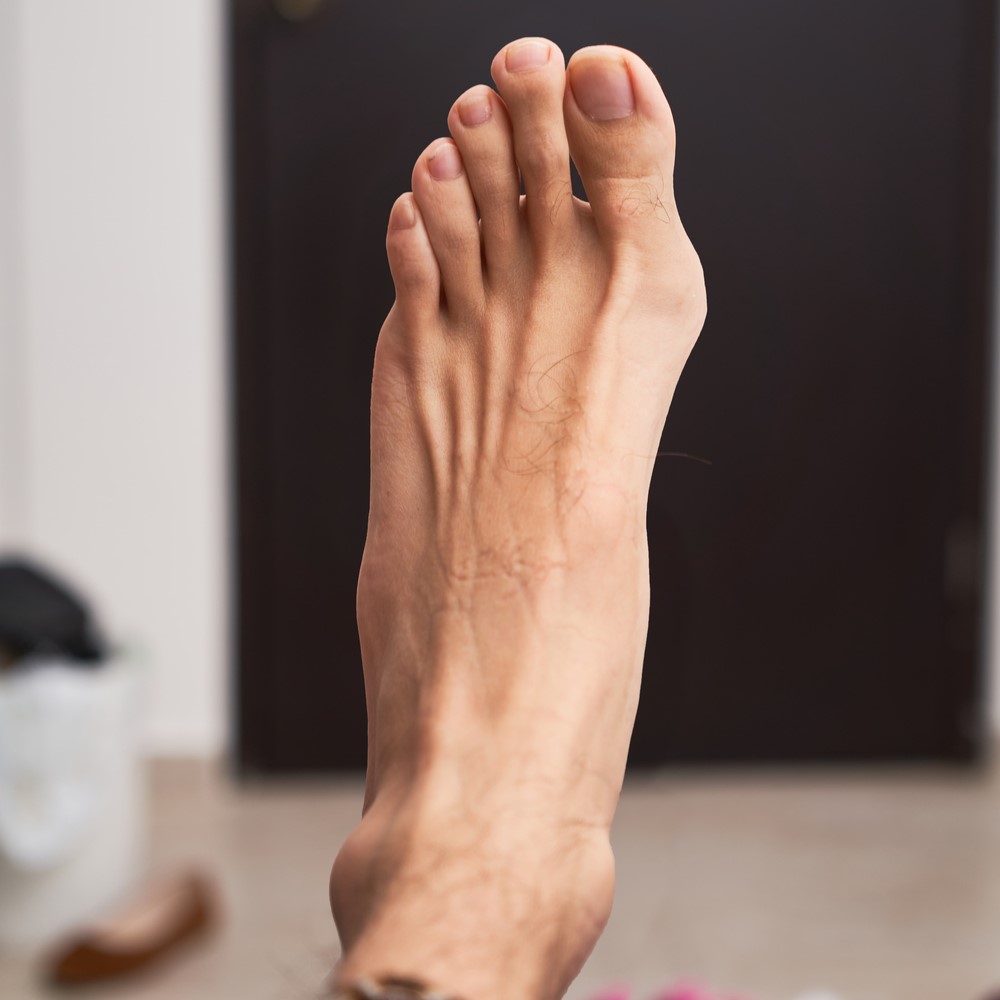 Finding Relief: Exploring Bunion Correction Options
