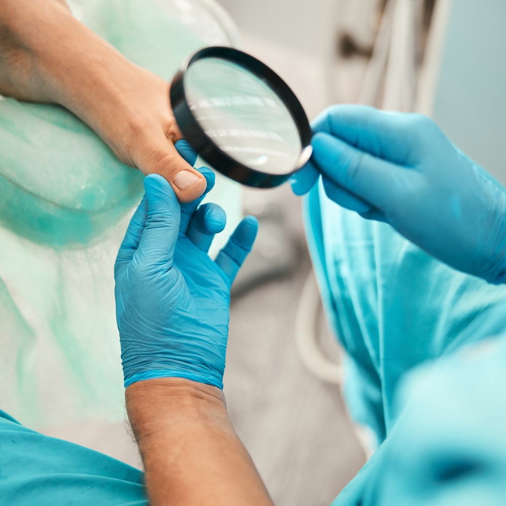 Needling for Verruca: What You Need to Know