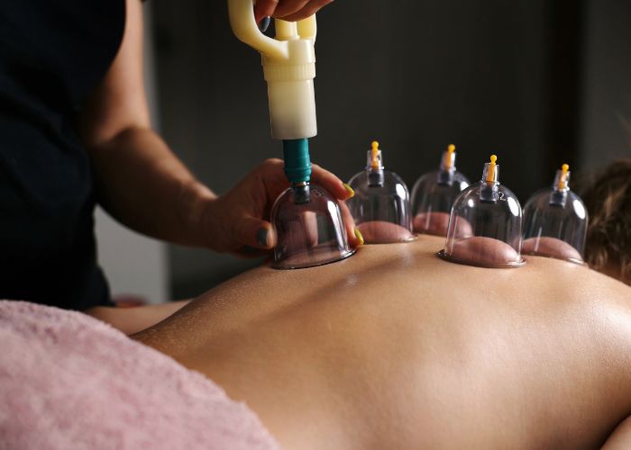 Cupping therapy (hijama) being performed on a patient’s back using suction cups for pain relief and improved circulation at a medical clinic in Abu Dhabi.